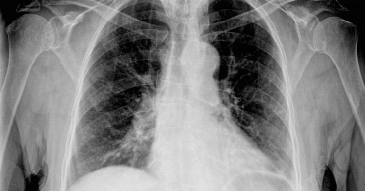 Fat Found In Overweight People’s Lungs